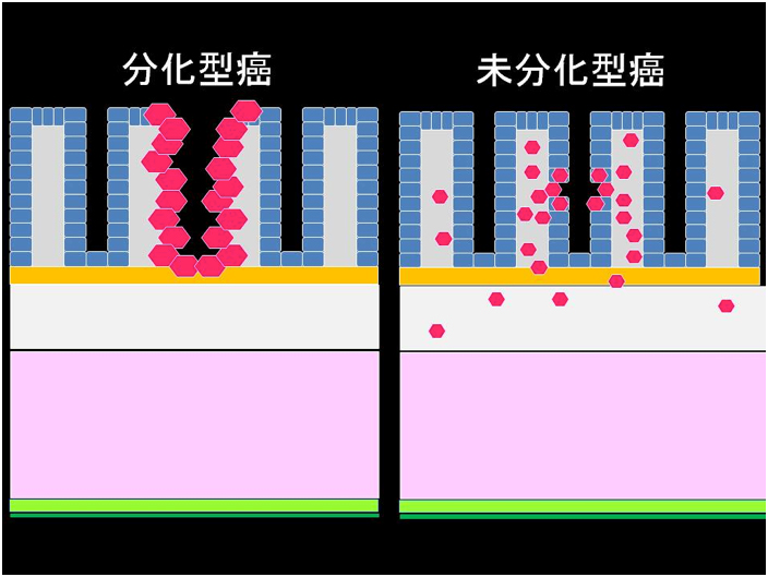 胃癌の組織型の違い