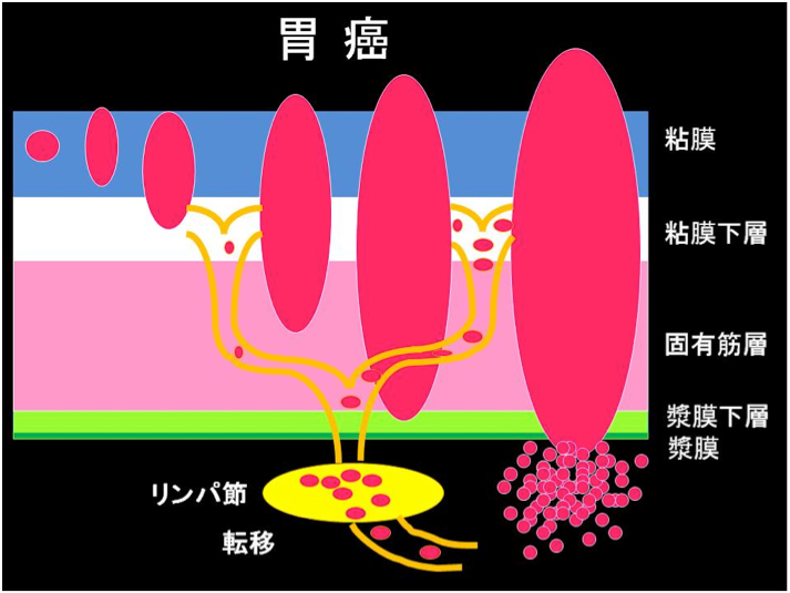 胃の壁の構造と、癌の深さ・リンパ節転移